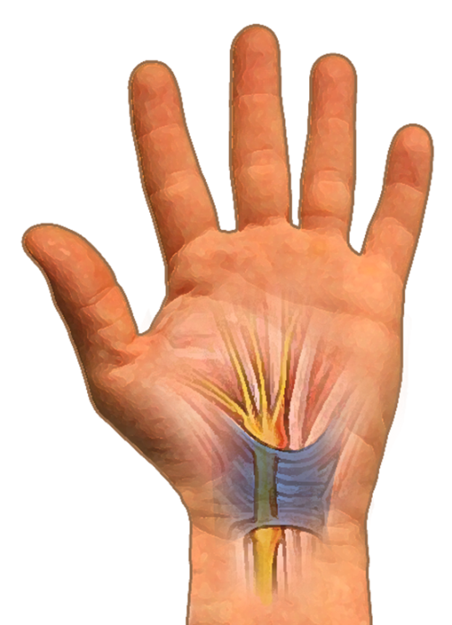 What is Carpal Tunnel Syndrome?