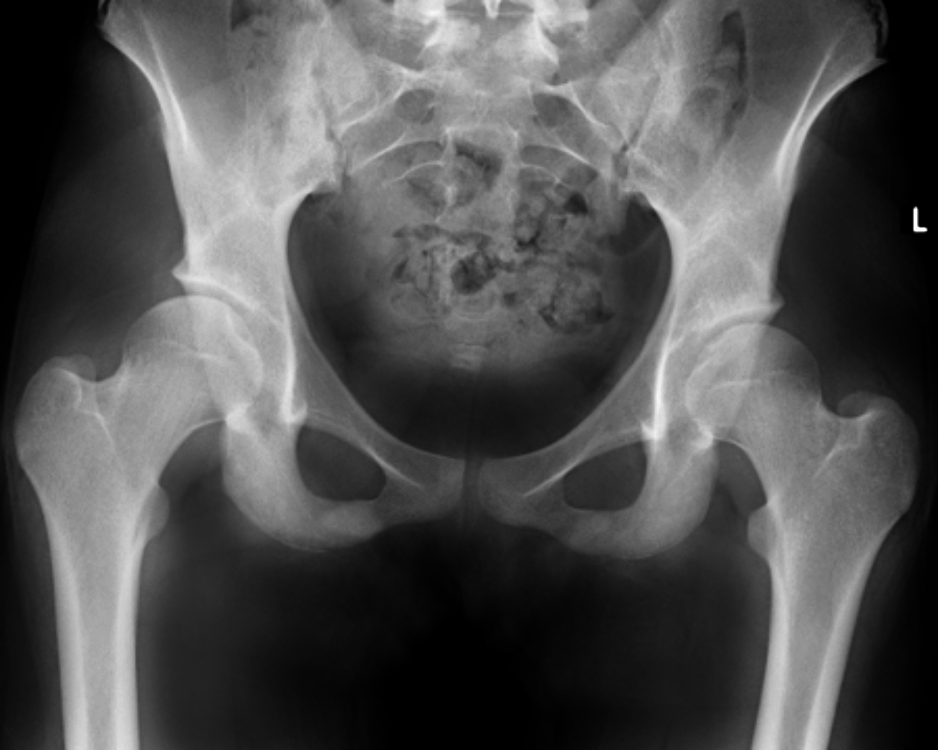 understanding-and-treating-hip-dysplasia