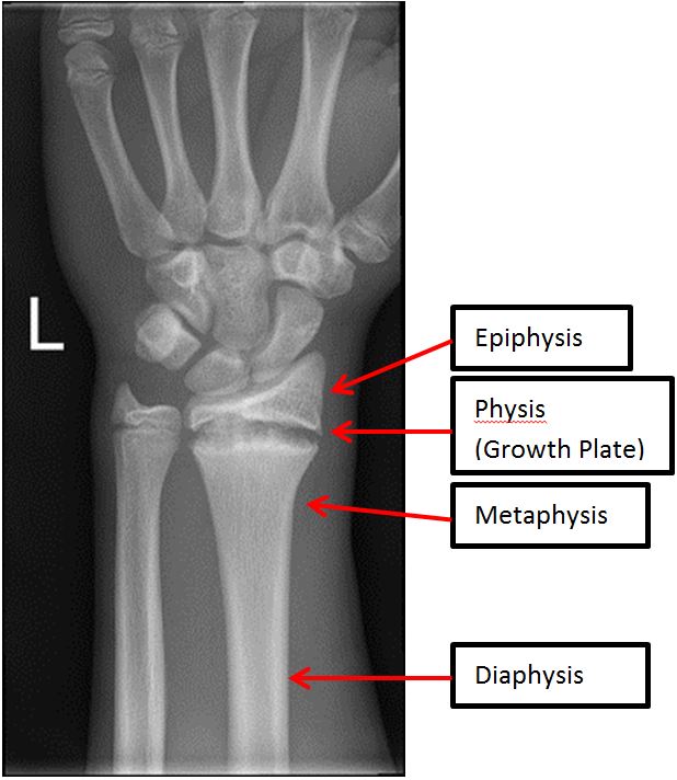 growth-plate-injuries-in-children-washington-orthopaedics-sports